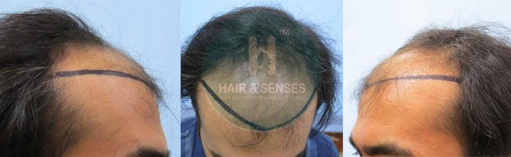 Hairline Designing 3100